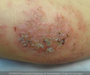 Dermatitis