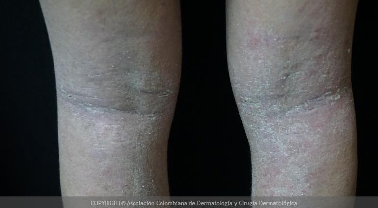 Dermatitis atopica