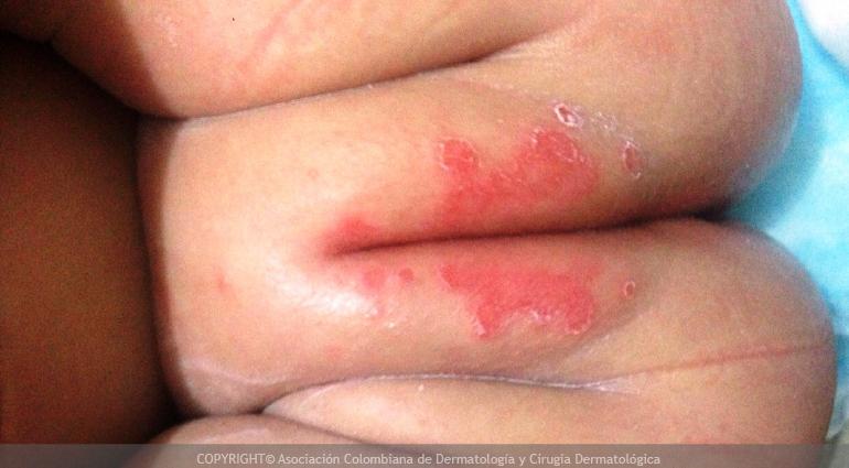 dermatitis de pañal